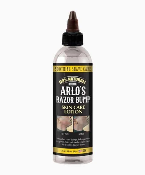 Arlo’s razor bump